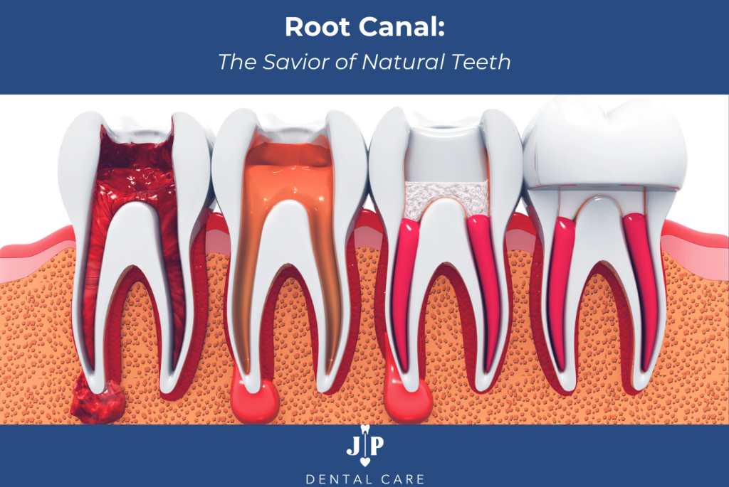 Root Canal The Savior of Natural Teeth